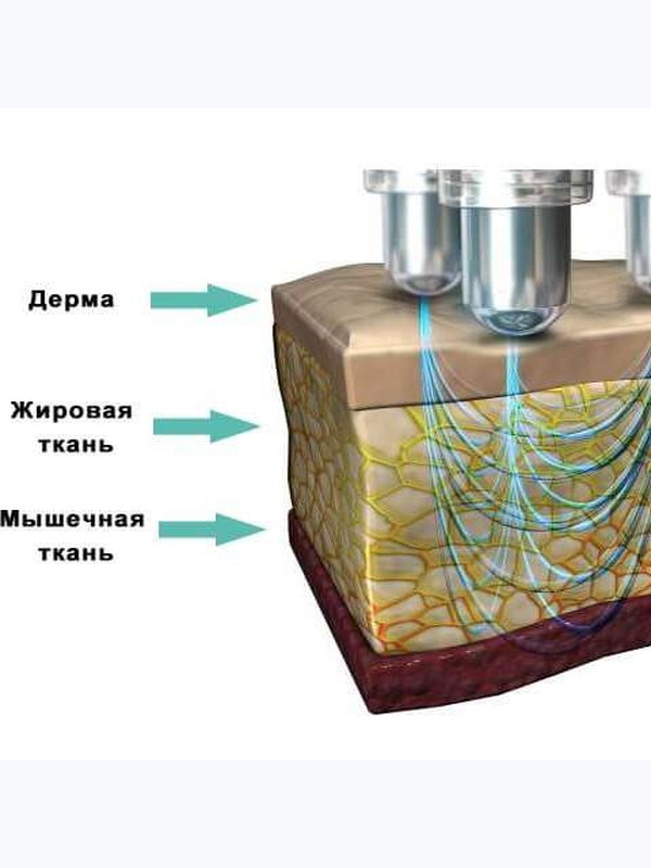 RF-лифтинг  тела и лица