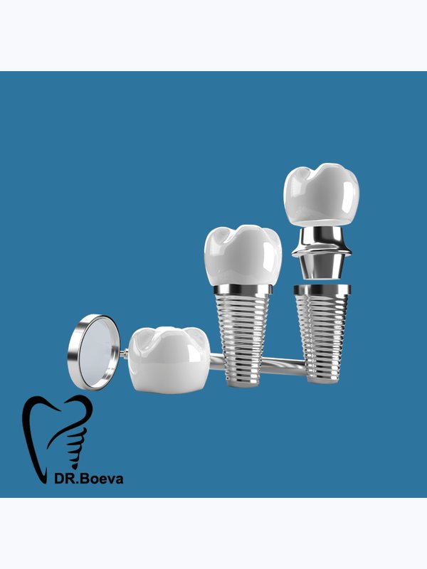 Внутрикостная дентальная имплантация / Dentium (Implantium, Superline, Slimline)