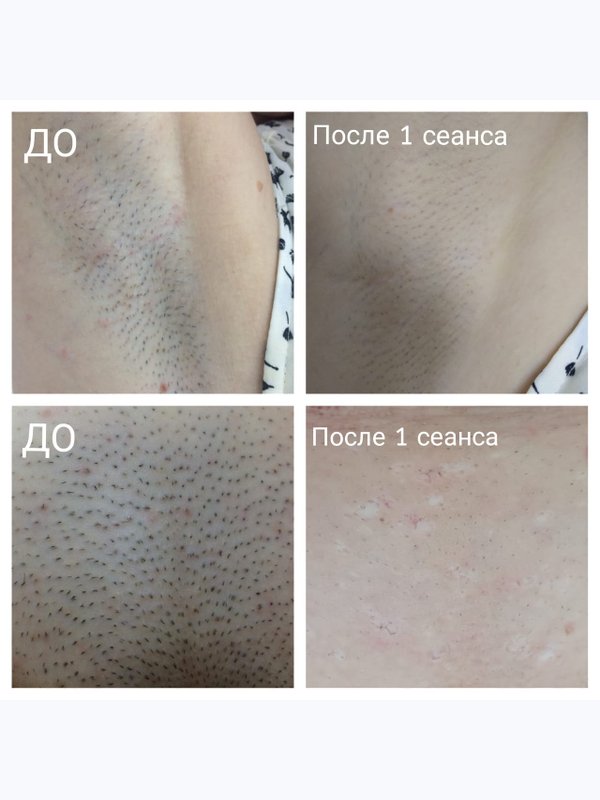 Лазерная эпиляция
