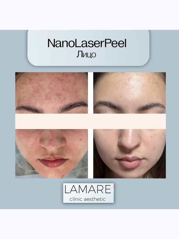 Лазерный пилинг кожи NanoLaserPeel Лицо