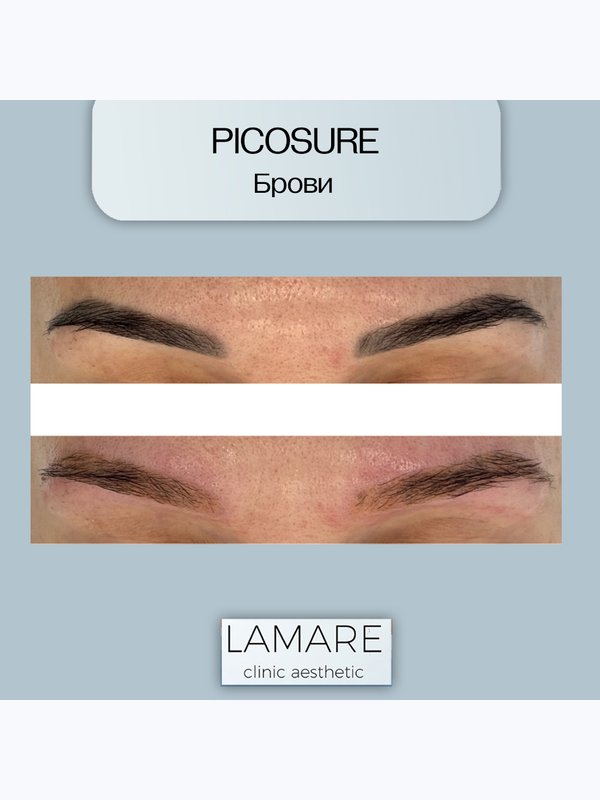 Удаление татуажа (брови) Picosure