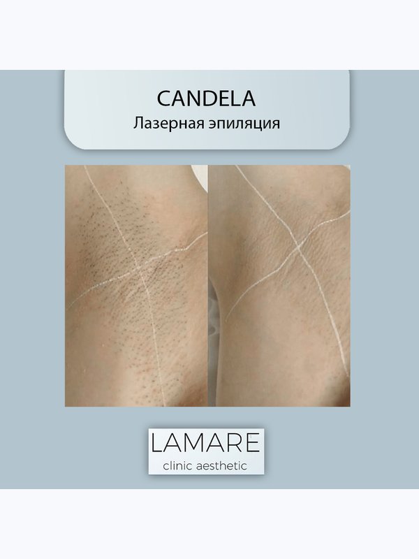 Лазерная эпиляция Candela
