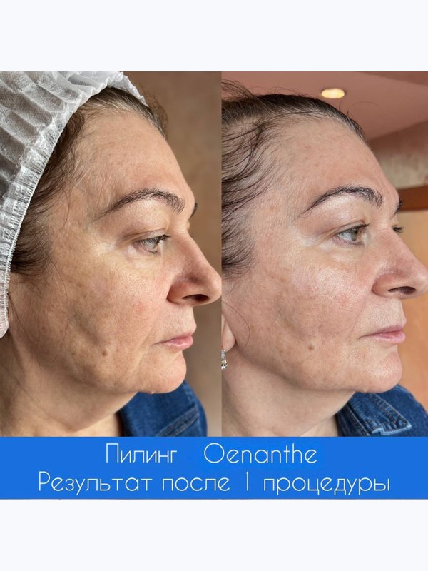 Пилинг OENANTE
