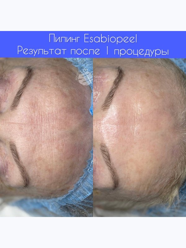 Пилинг ESABIOPEEL
