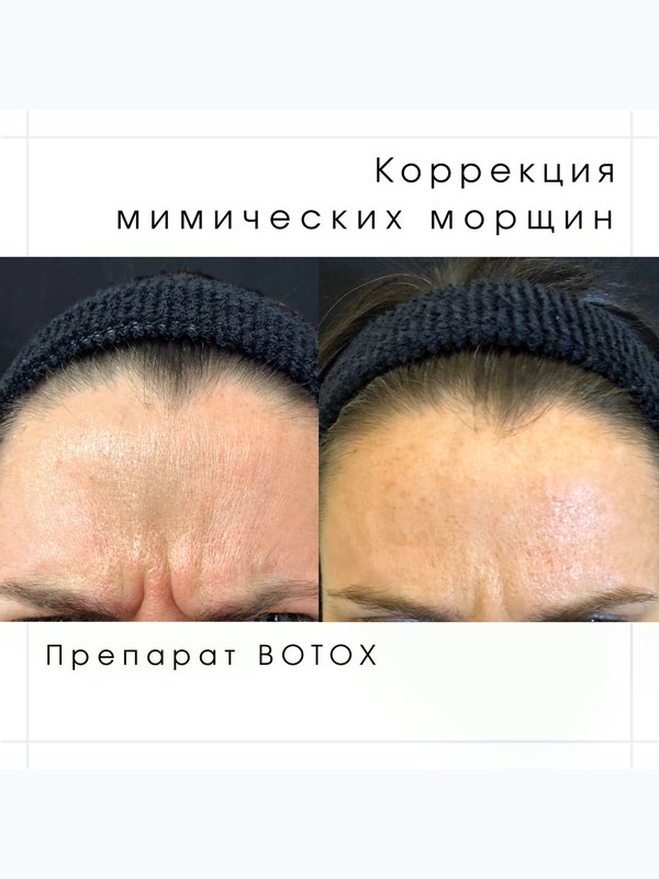 Ботокс, Ксеомин, Диспорт