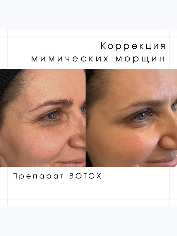 Ботокс, Ксеомин, Диспорт