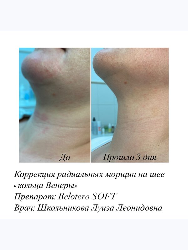 Контурная пластика филлерами на основе гиалуроновой кислоты