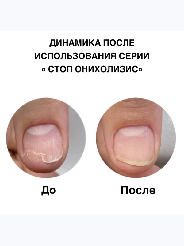 Бальзам регенерирующий для ногтей Стоп онихолизис