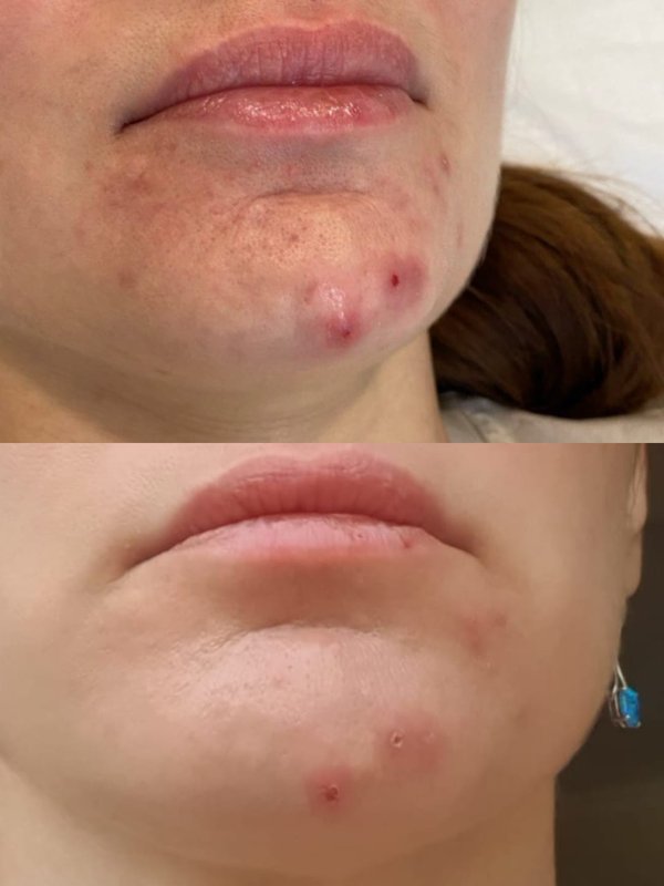 Лечение купероза, розацеа, акне,  омоложение