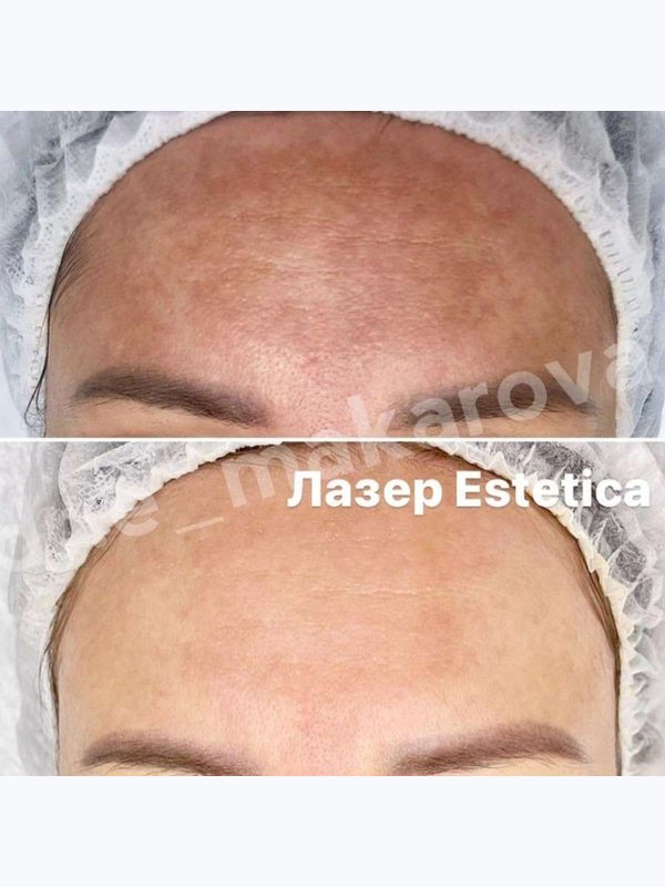 IPL  (Фототерапия) на аппарате Estetica 3.0