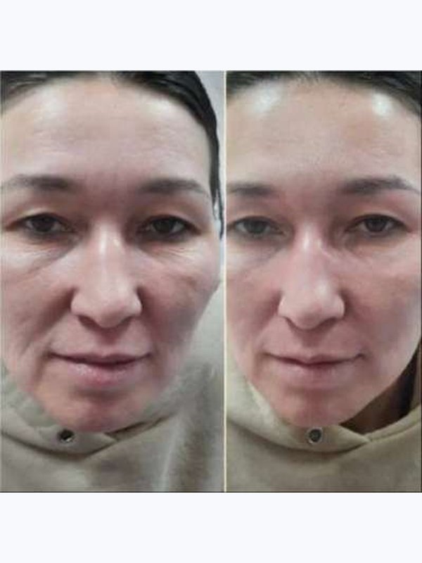 Усиливающие процедуры