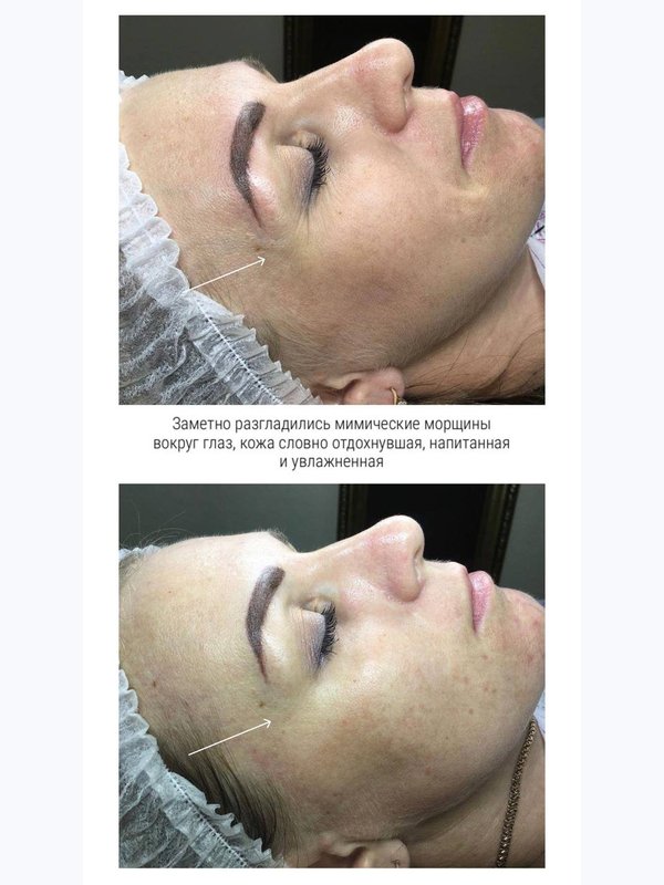Экспресс омоложение - мышечная маска  Elysien Multi Ex-Lifting