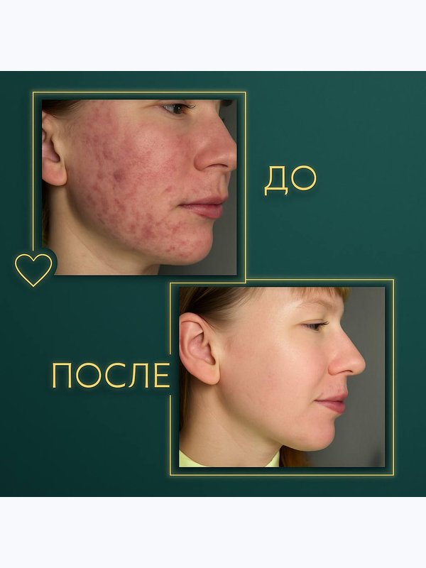 STOP акне лицо полностью