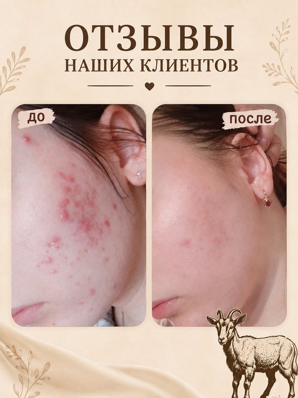 Мыло с эфирными маслами • акне • аллергия •опрелости