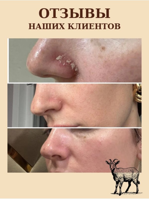 Крем для лица и тела • псориаз •дерматит • экзема • зуд • сухость
