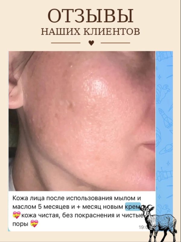 Крем для лица и тела • псориаз •дерматит • экзема • зуд • сухость