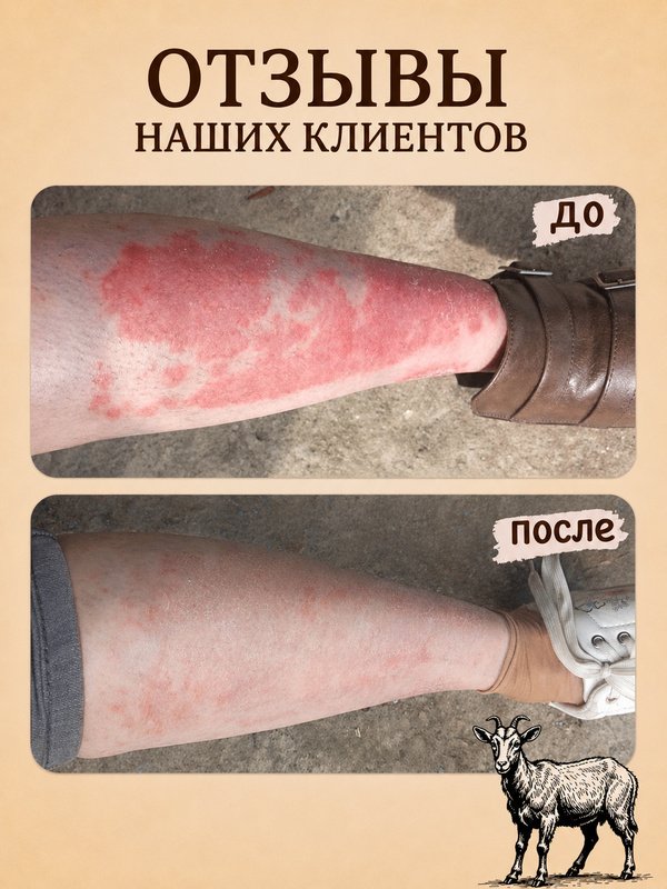 Мыло ММ • псориаз • дерматит • экзема