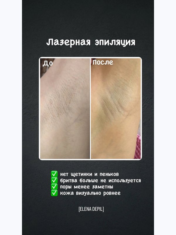 Лазерная эпиляция комплекс МИНИ