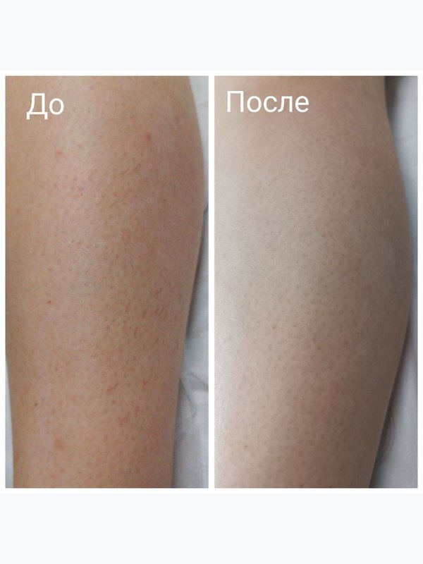 Лазерная эпиляция комплекс СТАНДАРТ