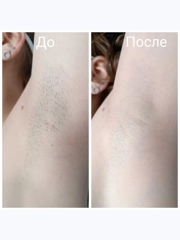 Лазерная эпиляция подмышечных впадин