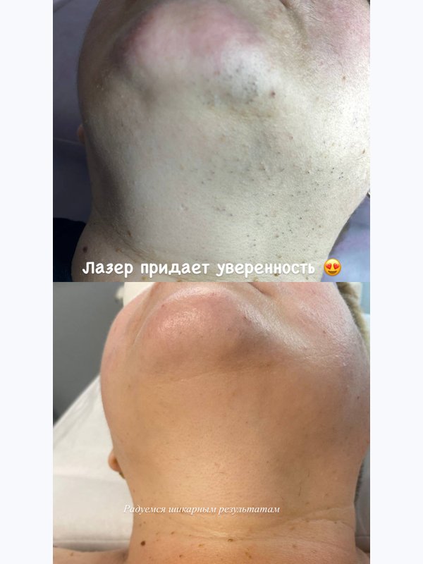 Лазерная эпиляция средняя зона (лицо, живот, ягодицы, поясница)