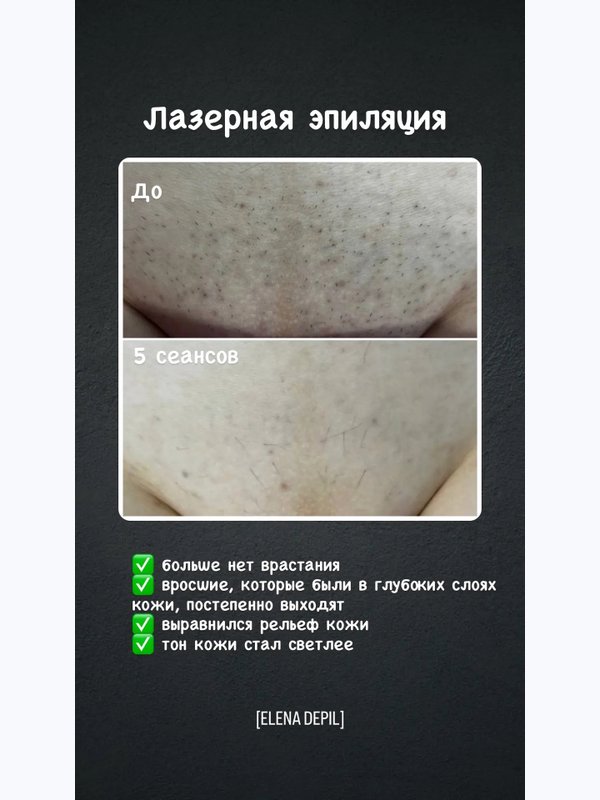 Лазерная эпиляция бикини