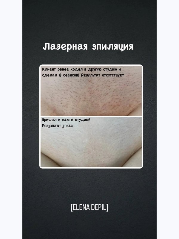 Лазерная эпиляция бикини