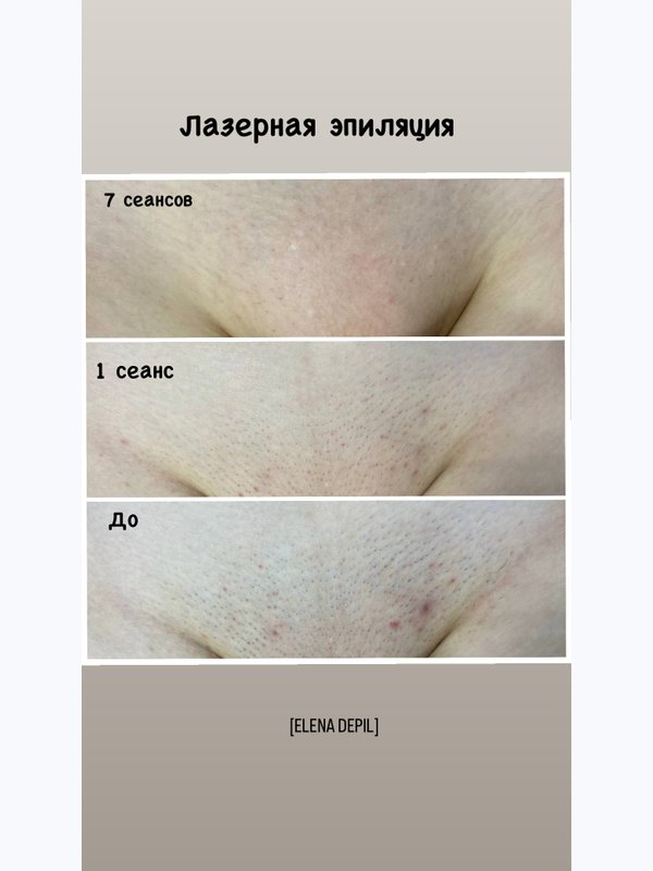Лазерная эпиляция комплекс СТАНДАРТ