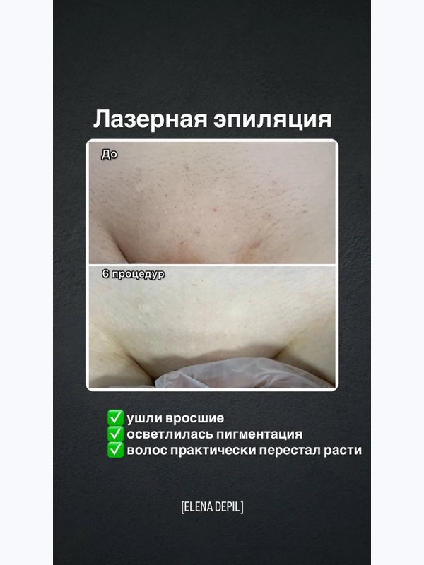 Лазерная эпиляция комплекс МИНИ