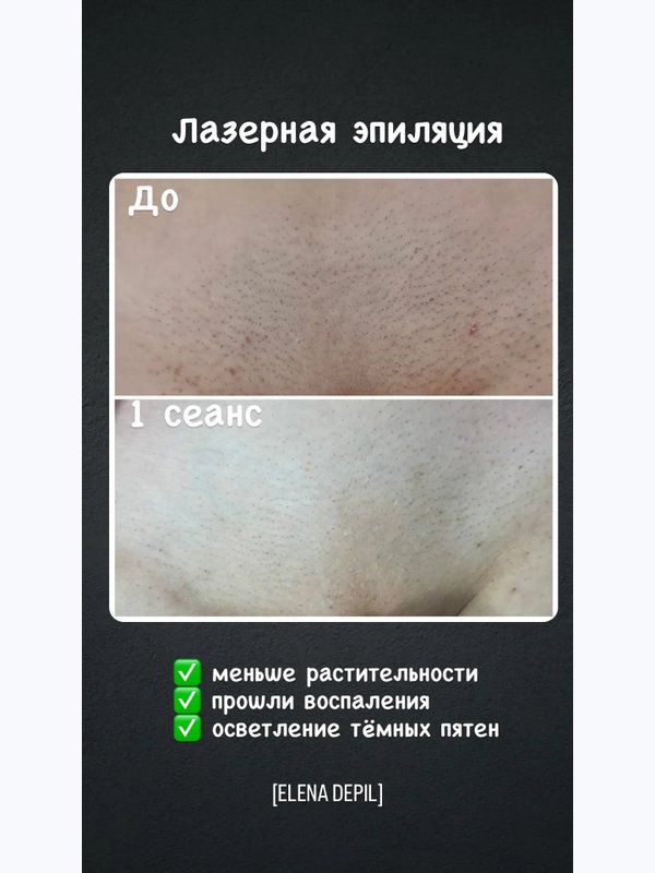 Лазерная эпиляция комплекс МИНИ