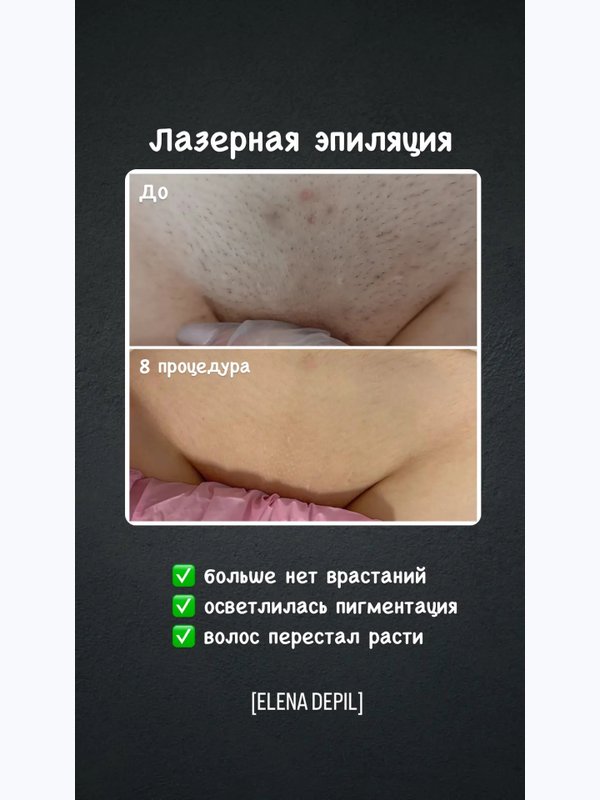 Лазерная эпиляция бикини