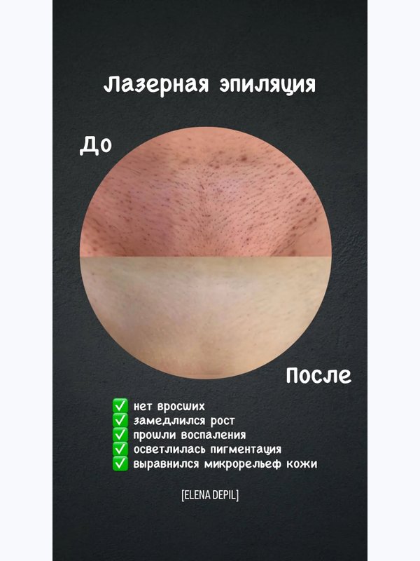 Лазерная эпиляция комплекс МИНИ