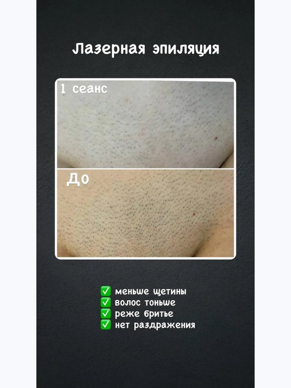 Лазерная эпиляция бикини