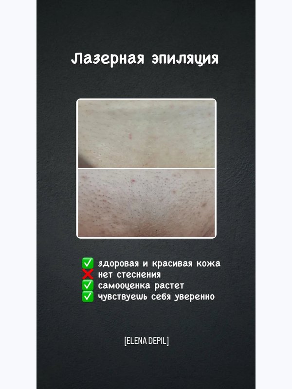 Лазерная эпиляция бикини
