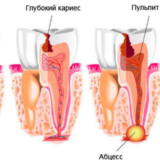 Пульпит и кариес отличия. Кариес пульпит периодонтит.