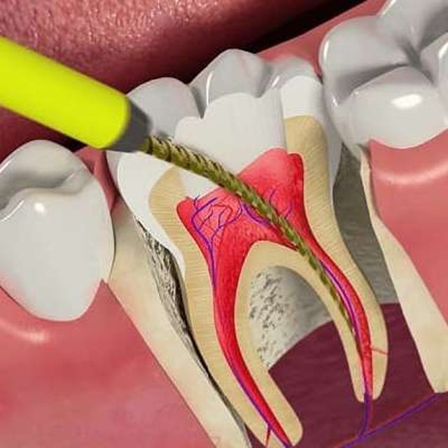 Инструмент для удаления нерва в зубе. Внутрикоронковое отбеливание депульпированного зуба. Пульпит корневого канала. Сколько по времени удаляют нерв в зубе. Пульпита (депульпирование зуба.